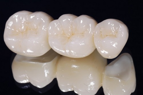 Thời gian bọc răng sứ mất bao lâu tại Nha khoa Hoàn Mỹ? 1