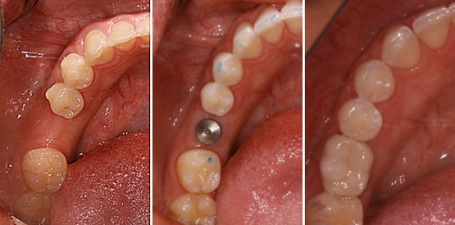 Trường hợp nào nên trồng răng Implant?2
