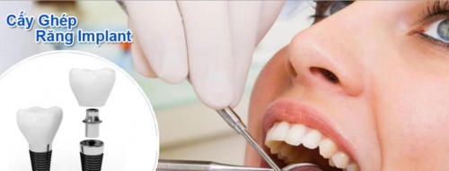 Ưu điểm vượt trội của cấy ghép răng Implant 4S là gì?4