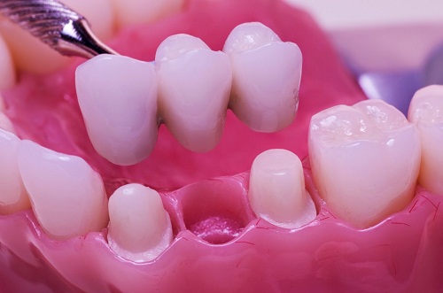 Phương pháp làm cầu răng có đau không? 2