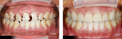 Có nên bọc răng sứ để khắc phục răng cửa thưa??
