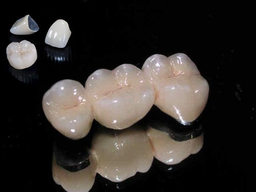 Răng sứ kim loại có độ bền cũng khá cao