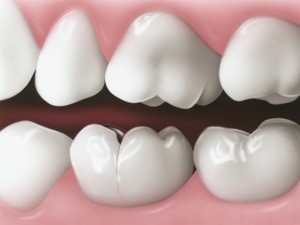 Bọc răng sứ có hại không?2