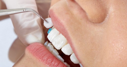 Mài cùi răng là thao tác bắt buộc trong bọc răng sứ - ảnh