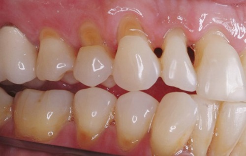 Răng bị mòn chủ yếu do ăn nhai mạnh hoặc tác dụng của axit