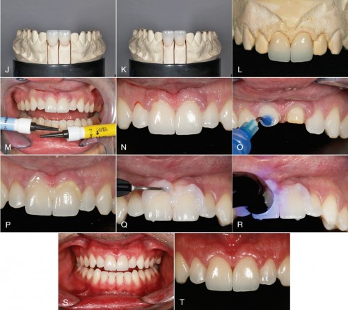 Quá trình chỉnh răng bị thưa bằng cách bọc răng sứ