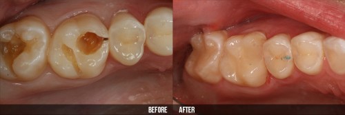 Làm răng hàm bằng răng sứ kim loại có tốt không 3