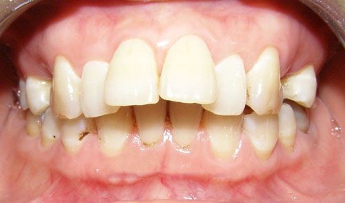 Làm thế nào để răng bớt vẩu an toàn nhất?1