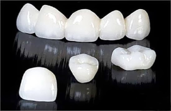 Răng toàn sứ Emax có độ bền bao lâu?