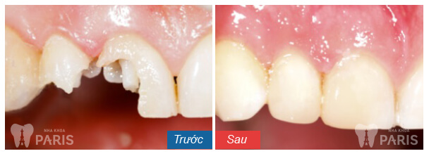 Những nguyên nhân răng bị mẻ bạn cần biết để phòng tránh 2
