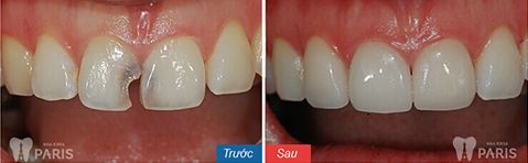 Bọc răng sứ có độ bền tối đa khi sử dụng công nghệ ct 5 chiều
