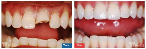 Bọc răng sứ bị đen chân răng - Nguyên nhân và cách khắc phục tốt nhất 5