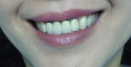 Bọc răng sứ bị đen chân răng - Nguyên nhân và cách khắc phục tốt nhất 1