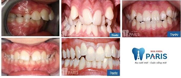 Bọc răng sứ hay niềng răng - Phương pháp nào tối ưu với bạn nhất? 2