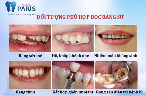 Bọc răng sứ hay niềng răng - Phương pháp nào tối ưu với bạn nhất? 1