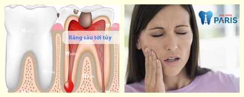 Răng sâu ăn vào tủy – Nguyên nhân và cách khắc phục dứt điểm nhất 1