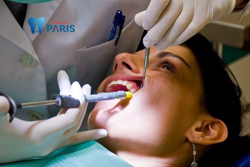 Răng sâu ăn vào tủy – Nguyên nhân và cách khắc phục dứt điểm nhất 2