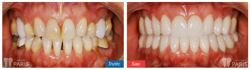 Cách nào chữa 2 răng cửa bị vẩu nhanh chóng nhất?