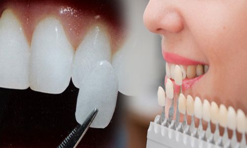 Chia sẻ: Bọc răng sứ có cần phải lấy tủy răng không?