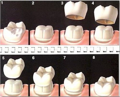 Quy trình bọc mão răng sứ với công nghệ CT5 chiều