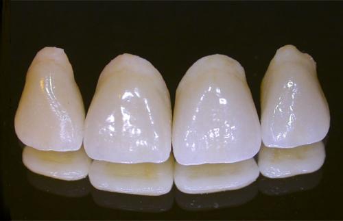 Răng sau khi bọc sứ bị lung lay phải làm sao?