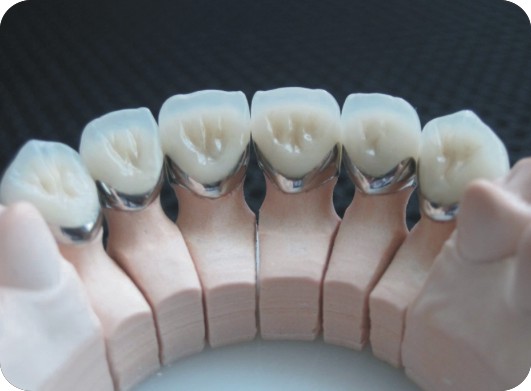 Tại sao bọc răng sứ kim loại bị xỉn màu và cách khắc phục là gì?