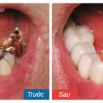 Lê Thanh Tú: Phục hình răng sứ cho răng sâu nặng