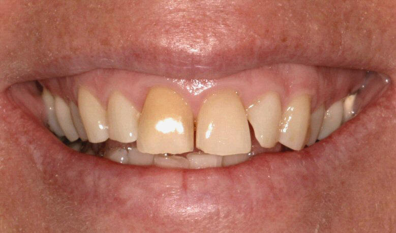 Giải pháp khắc phục răng nhiễm màu Tetracycline hiệu quả