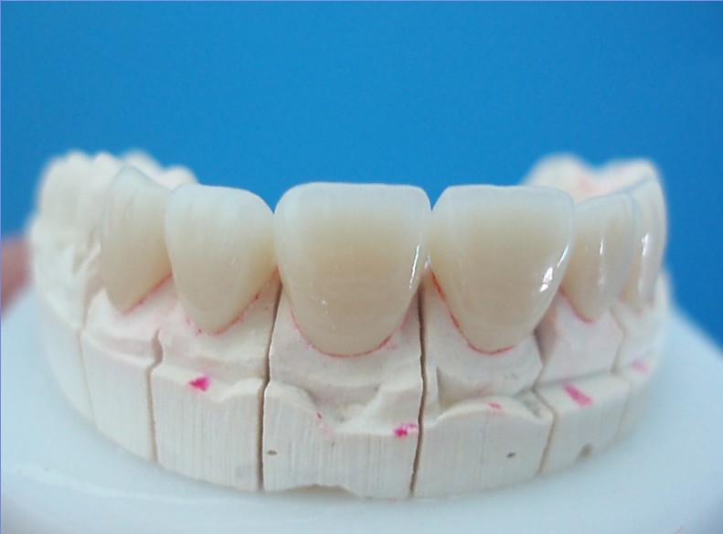 Răng cửa sứ bị mẻ phải làm sao để khắc phục?