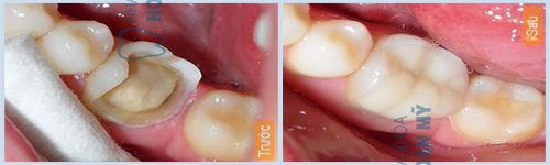 Bọc răng sứ kim loại có bền không? Chuyên gia nha khoa tư vấn