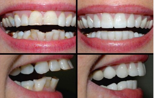 Cách làm răng đỡ vẩu nhanh chóng có hàm răng đều và đẹp