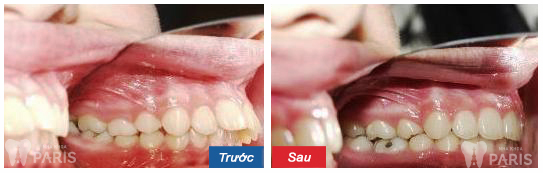 Cách điều trị răng vẩu nào cho hiệu quả nhanh nhất?