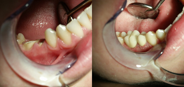 Răng sâu bị vỡ lớn có thể bọc sứ được không? 2