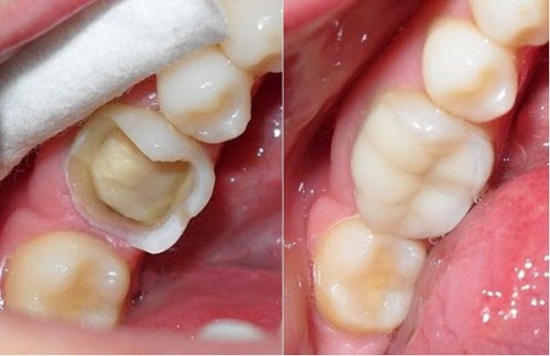 Trong quy trình bọc sứ, khi mài răng có đau không?