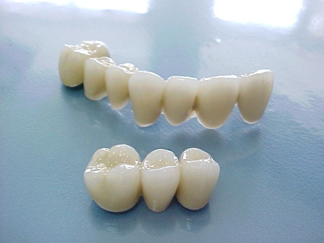 Bọc răng sứ kiêng gì? Loại răng sứ nào có độ bền chắc tốt nhất 2