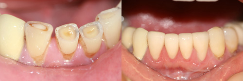 Khắc phục răng mòn men bằng bọc sứ có hiệu quả không?