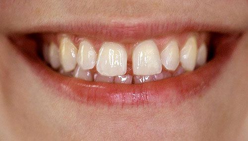 Vì sao răng bị thưa và cách điều trị răng thưa nhanh nhất