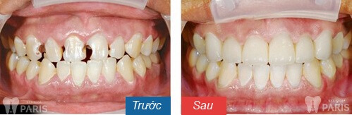 Bọc răng sứ bị sâu - Nguyên nhân và cách khắc phục Triệt Để nhất 6