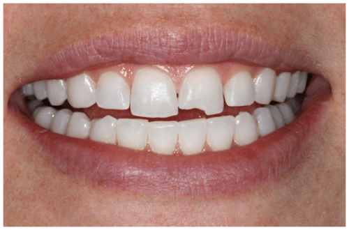 Phương pháp chữa sứt răng HIỆU QUẢ nhanh chóng để có răng đẹp