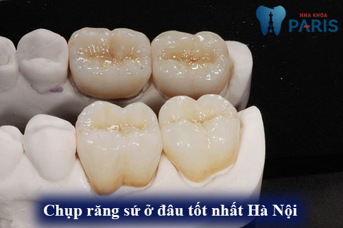 Chụp răng sứ ở đâu Tốt nhất và có Bảo Hành tại Hà Nội