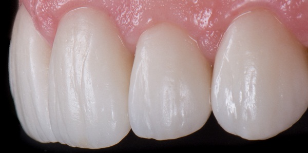 Viêm lợi sau khi bọc răng sứ - Nguyên nhân và cách khắc phục Triệt Để 1