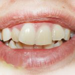 Bị lệch răng cửa phải làm sao để hàm răng đều đẹp trở lại?