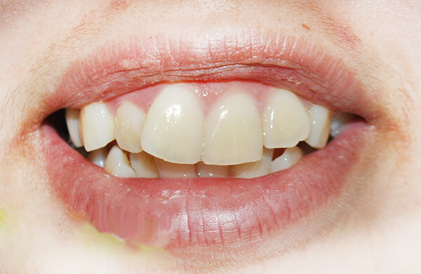 Bị lệch răng cửa phải làm sao để hàm răng đều đẹp trở lại?