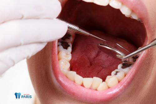 Răng sâu độ 3: Biểu hiện và cách điều trị dứt điểm bạn nên biết 1