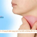 Khô cổ họng – Nguyên nhân & Cách chữa trị DỨT ĐIỂM chỉ sau 3 ngày