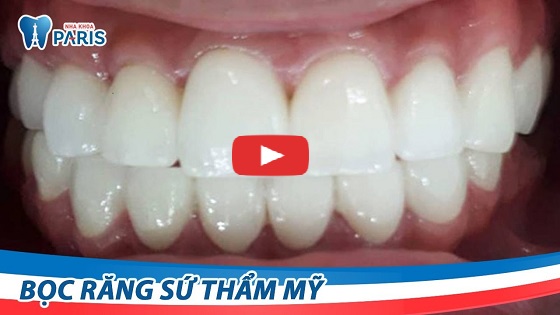 Bọc răng sứ - Phục hình răng chắc đẹp VĨNH VIỄN không đau nhức 6
