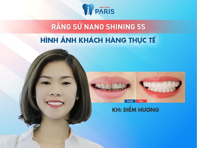Địa chỉ bọc răng sứ ở đâu TỐT Đảm Bảo BỀN & ĐẸP nhất tại Việt Nam 6