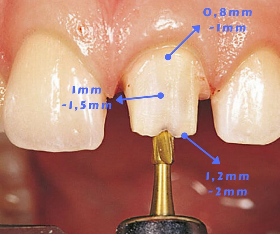 Quá trình mài răng theo các bước "KHÔNG ĐAU" CHUẨN tỉ lệ cụ thể 6