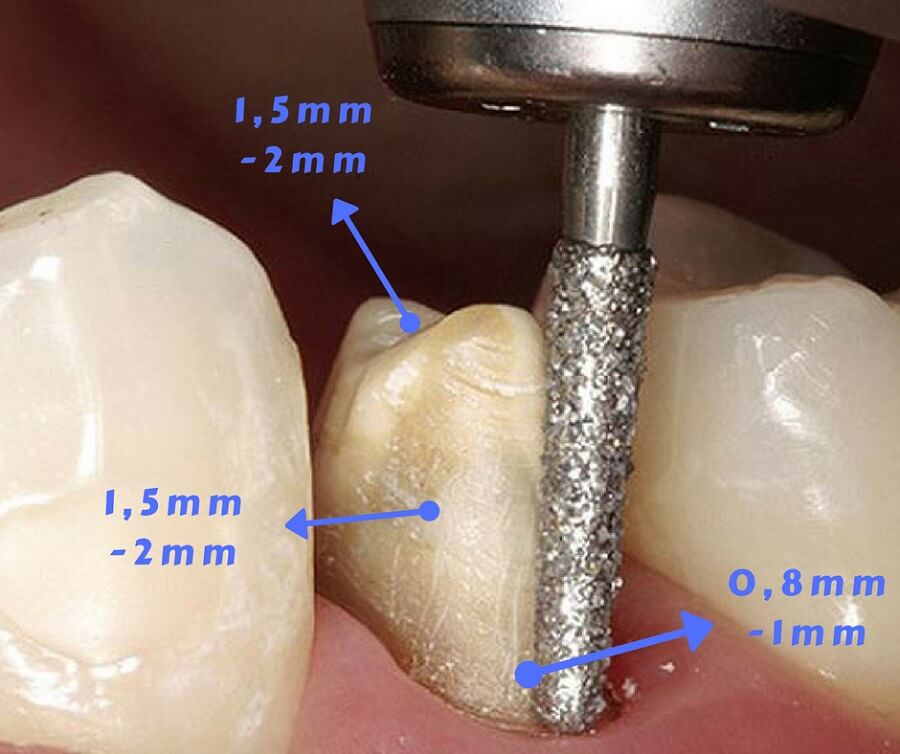 Quá trình mài răng theo các bước "KHÔNG ĐAU" CHUẨN tỉ lệ cụ thể 7