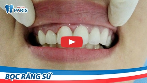 Bọc răng sứ - Phục hình răng chắc đẹp VĨNH VIỄN không đau nhức 6